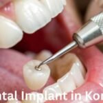 Dental Implant in Korea